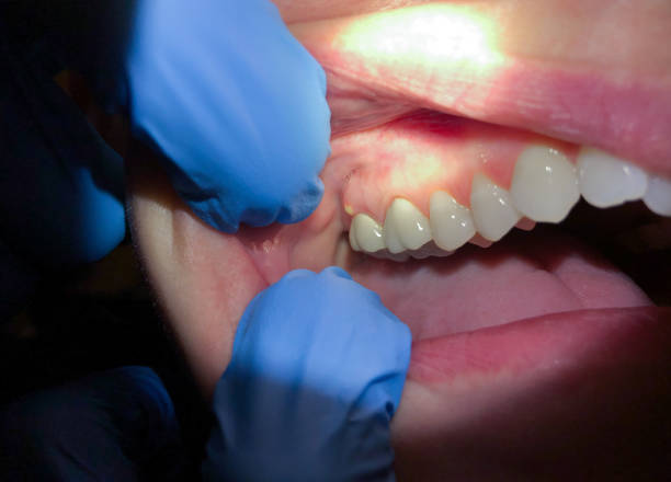 Best Emergency Wisdom Teeth Removal in Brentwood, PA