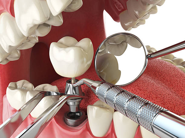 Best Emergency Root Canal Treatment in Brentwood, PA